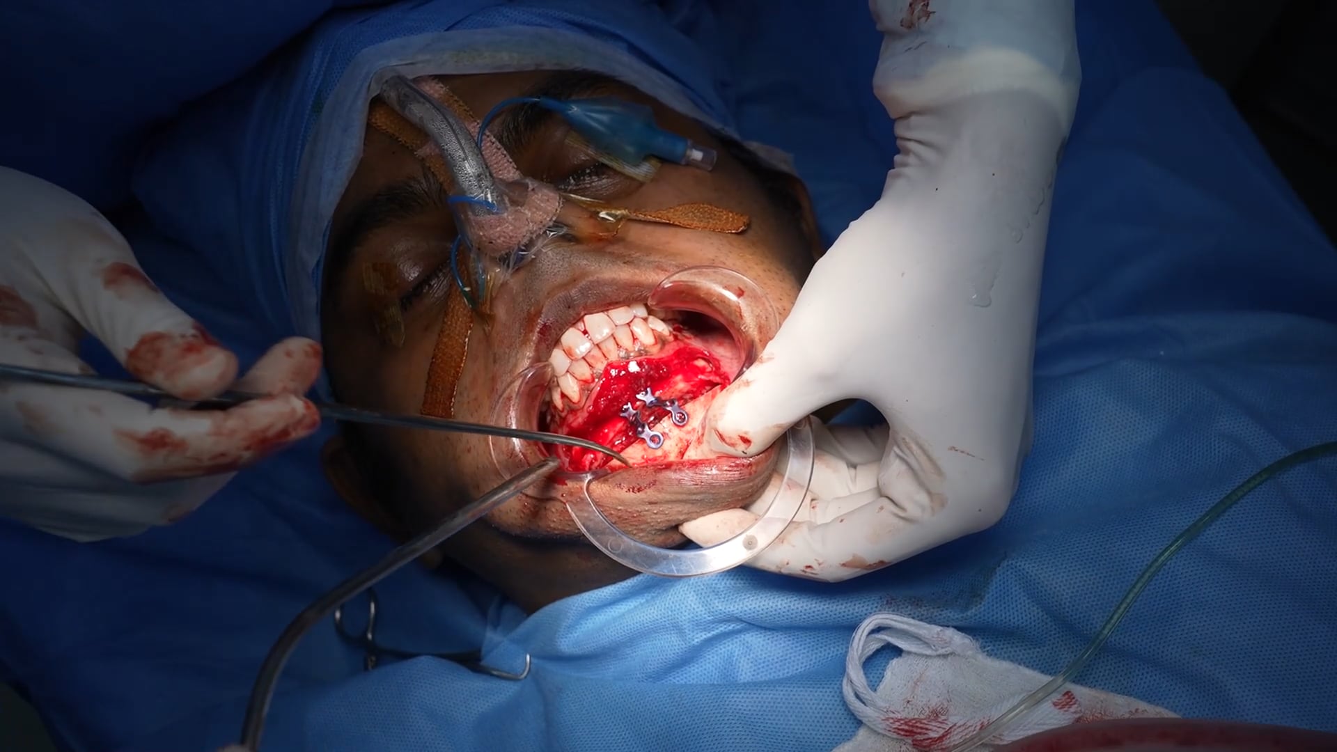 Genioplasty for a Man